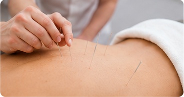 Close-up of acupuncture needles being placed in a patient’s back during treatment.